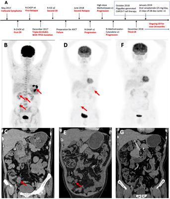 PiggyBac-Generated CAR19-T Cells Plus Lenalidomide Cause Durable Complete Remission of Triple-Hit Refractory/Relapsed DLBCL: A Case Report